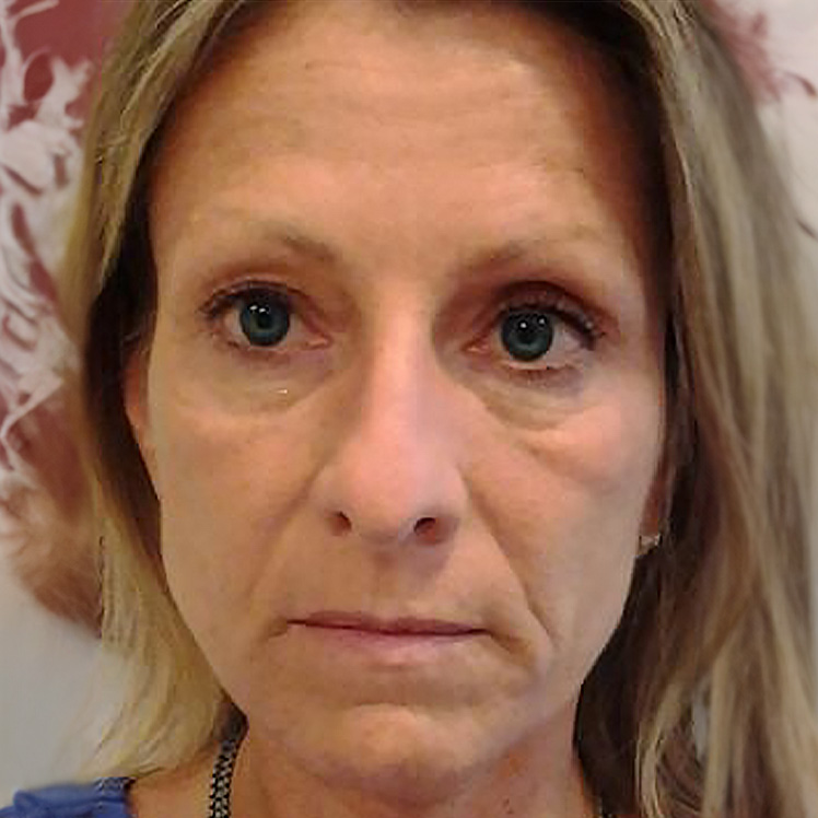 Lily before dermatica anti-ageing treatment