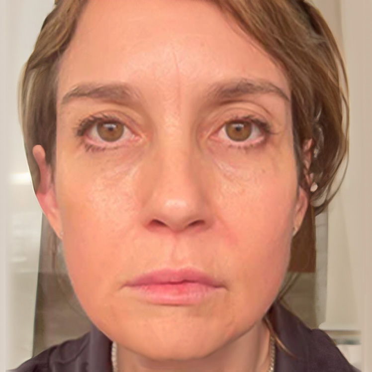 Lily after dermatica anti-ageing treatment