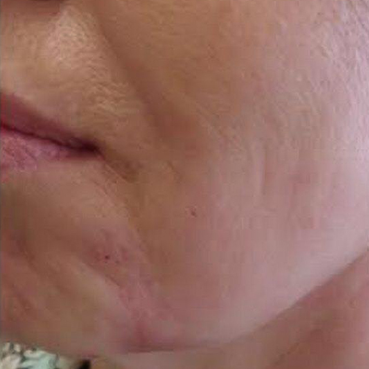 Lily after dermatica anti-ageing treatment