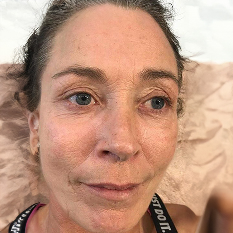 Lily before dermatica anti-ageing treatment