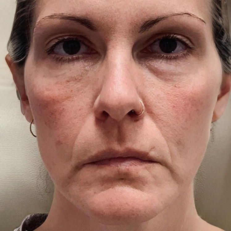 Lily before dermatica anti-ageing treatment