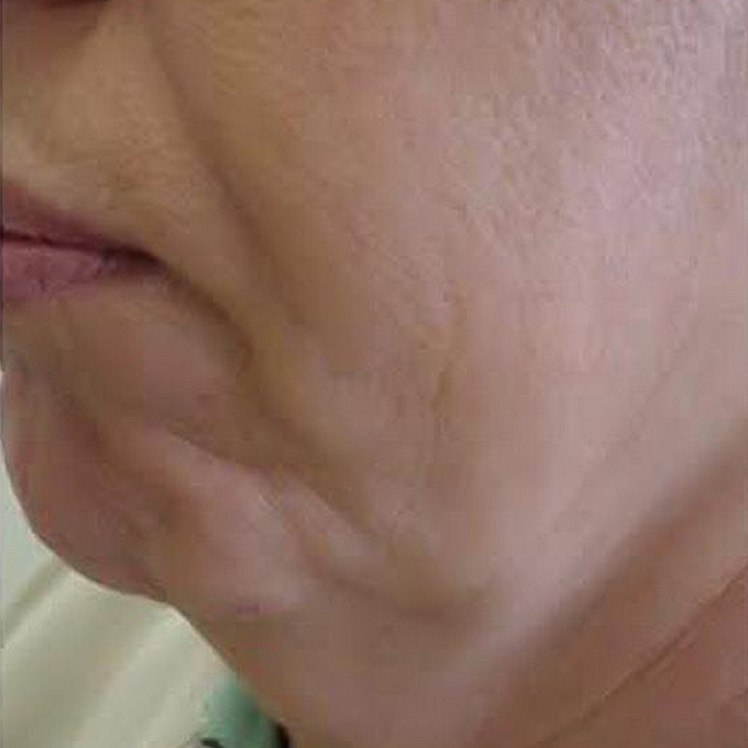 Lily before dermatica anti-ageing treatment