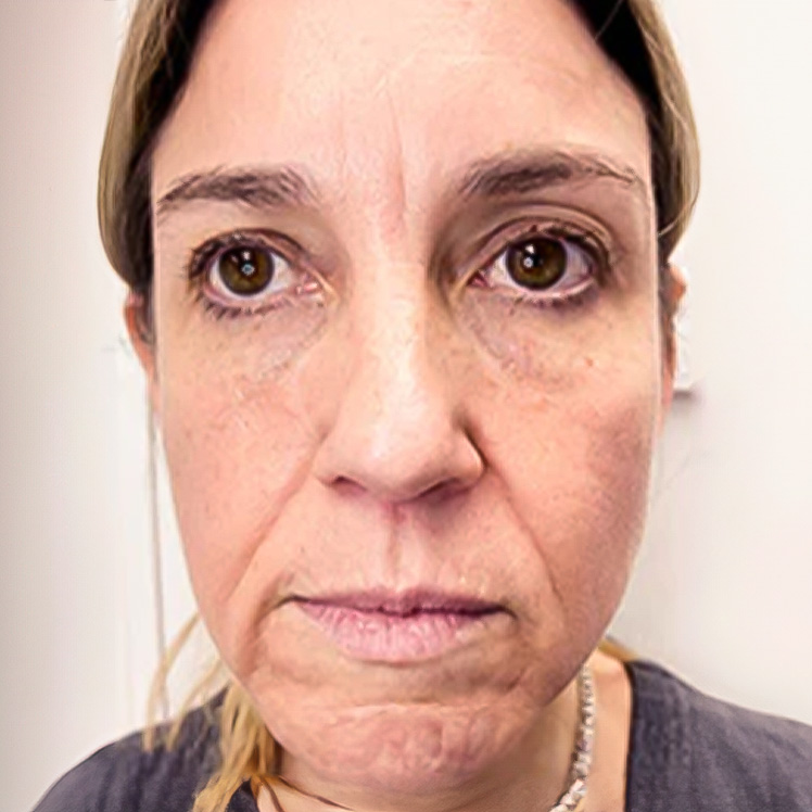 Lily before dermatica anti-ageing treatment