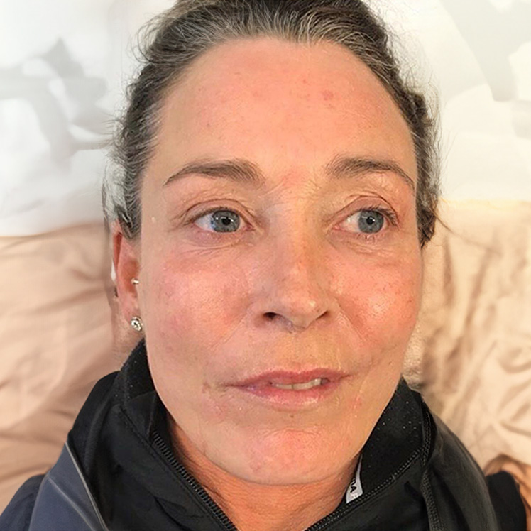 Lily after dermatica anti-ageing treatment