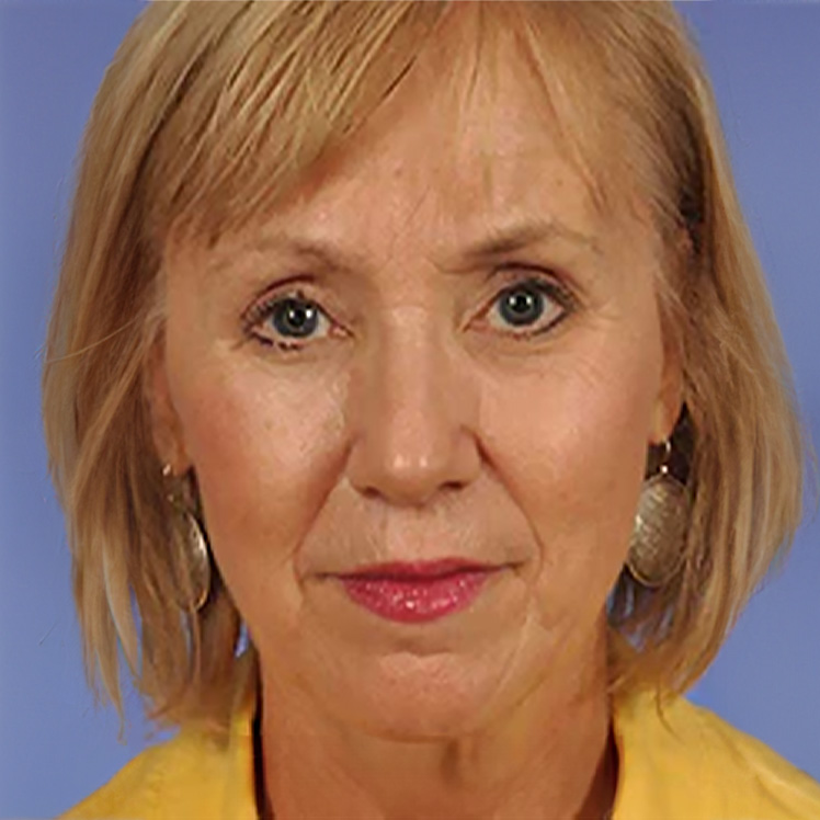 Lily after dermatica anti-ageing treatment