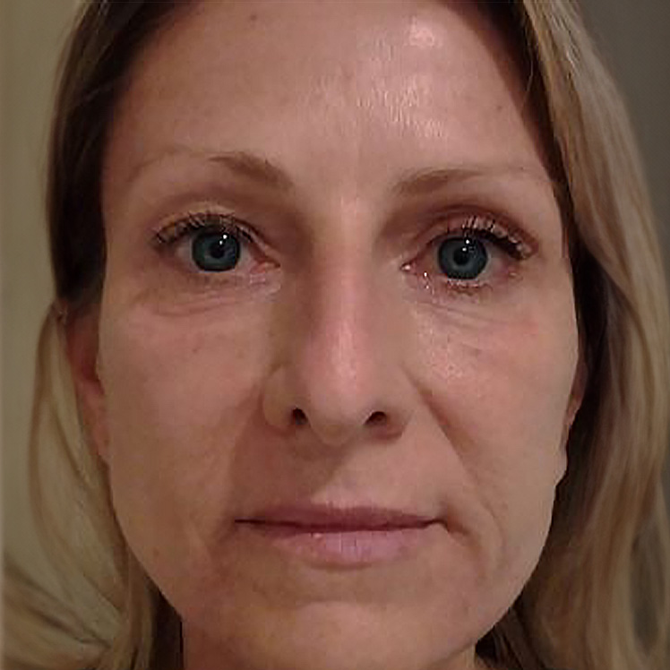 Lily after dermatica anti-ageing treatment