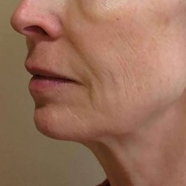 Lily before dermatica anti-ageing treatment