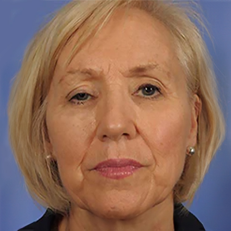 Lily before dermatica anti-ageing treatment