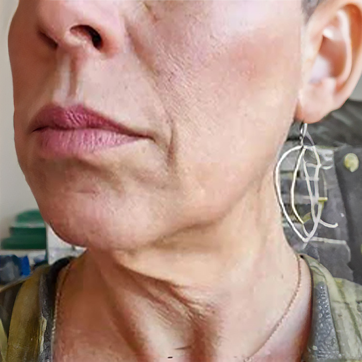Lily before dermatica anti-ageing treatment