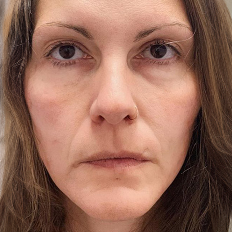 Lily after dermatica anti-ageing treatment