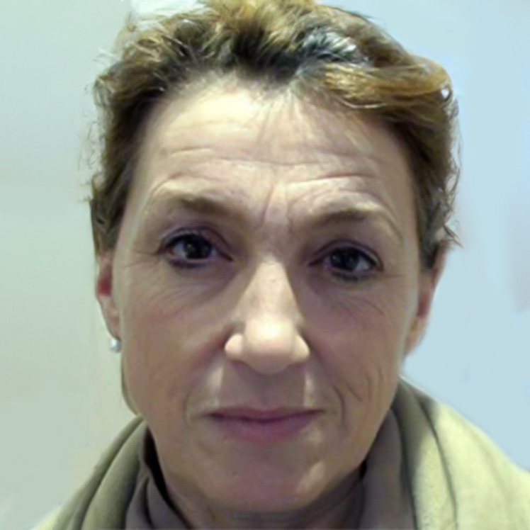 Lily before dermatica anti-ageing treatment