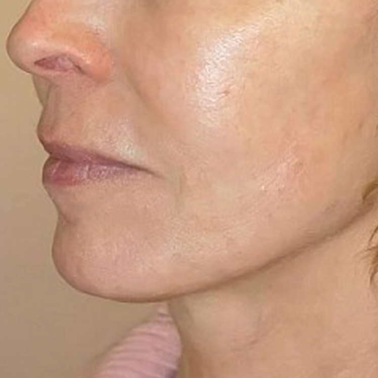 Lily after dermatica anti-ageing treatment